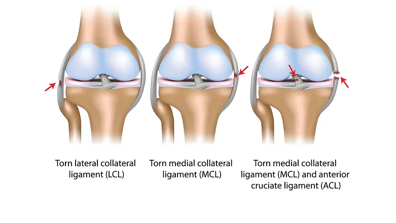ACL Ligament Tear 1