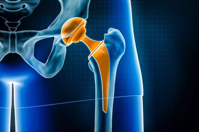 Carolina Regional Orthopaedics hip replacement
