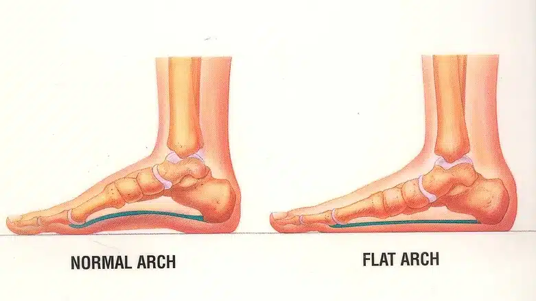 Flat Foot Deformity