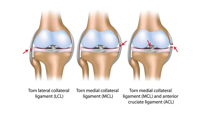 PCL Ligament Tear