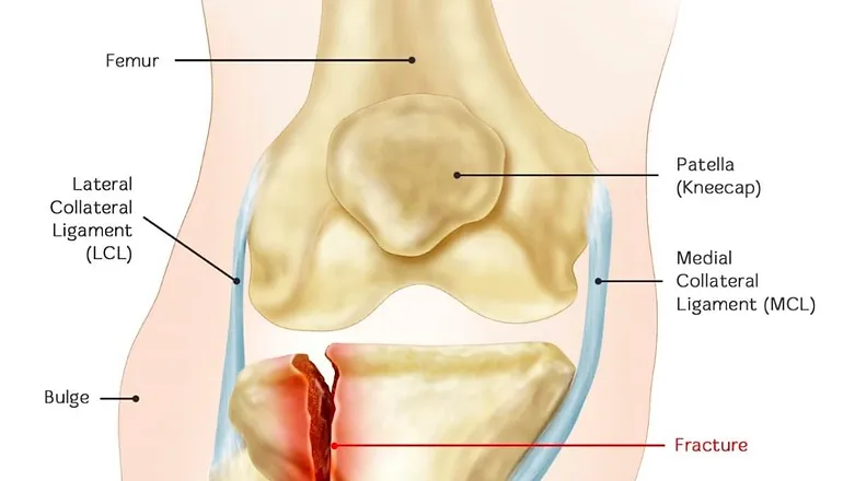 Proximal Tibia Fibula Fracture